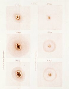 Comparing smallpox pustules between people with one (left) vs. two (right) inoculations