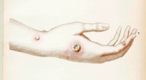 Sarah Nelmes’s hand with cowpox pustules