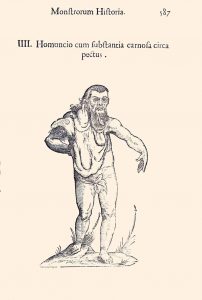 Indian gentleman with Neurofibromatoses 1, page 587, Aldrovandi's Monstrorum historia, 1642. BBML